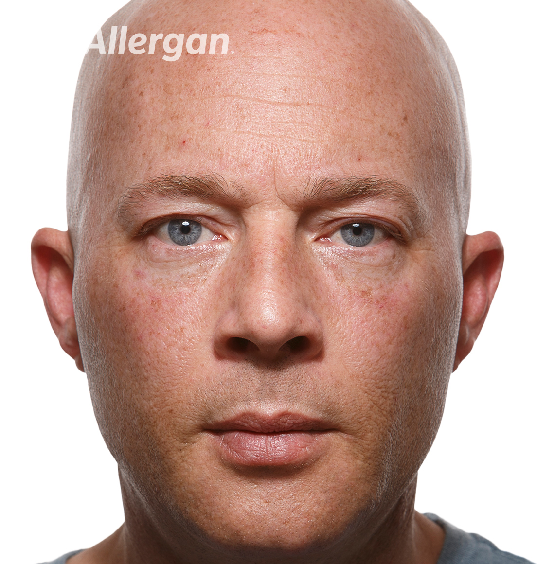 Juvederm | Caucasian male model 1 After