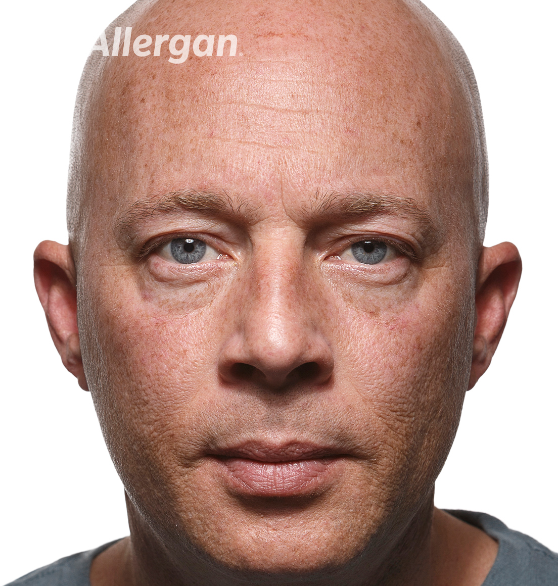 Juvederm | Caucasian male model 1 Before