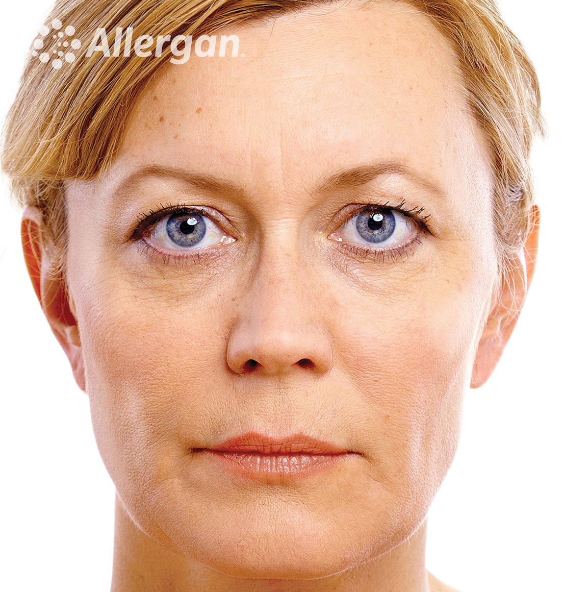 Juvederm | Caucasian female model Blonde 1 After