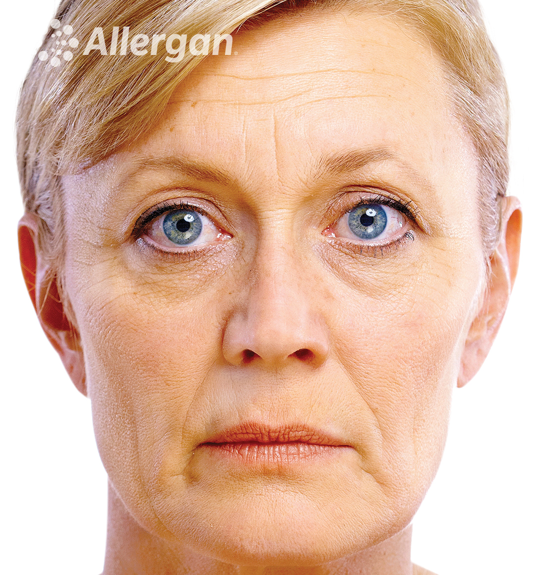 Juvederm | Caucasian female model Blonde 1 Before