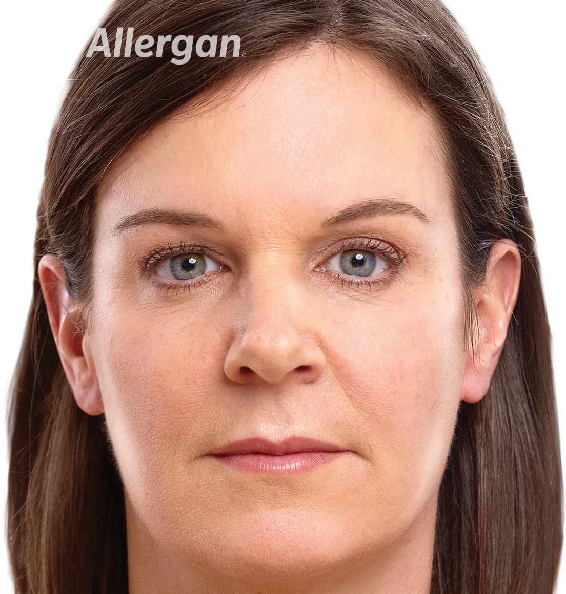 Juvederm | Caucasian female model Brunette 2 After