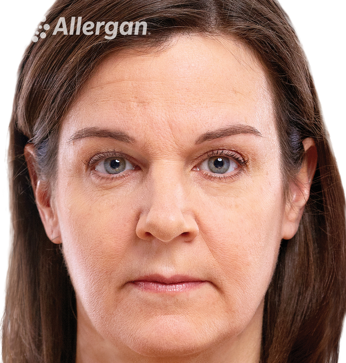 Juvederm | Caucasian female model Brunette 1 Before