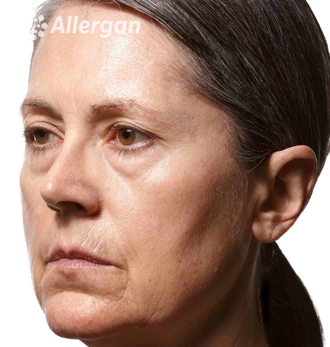 Juvederm | Caucasian female model 1 Before angled