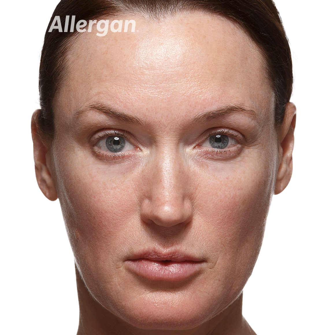 Juvederm | Caucasian female model After