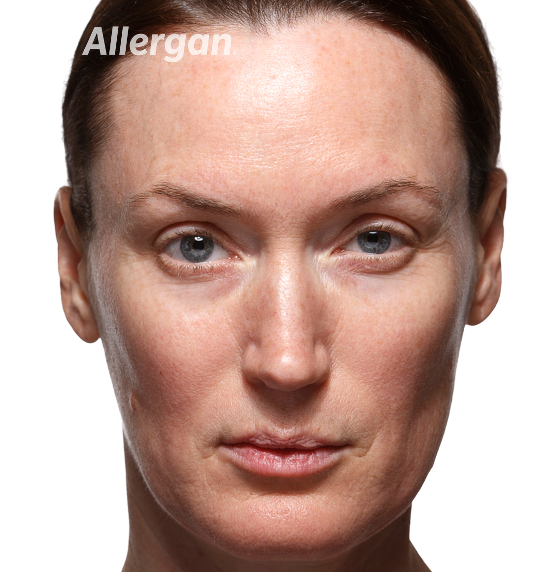 Juvederm | Caucasian female model Before
